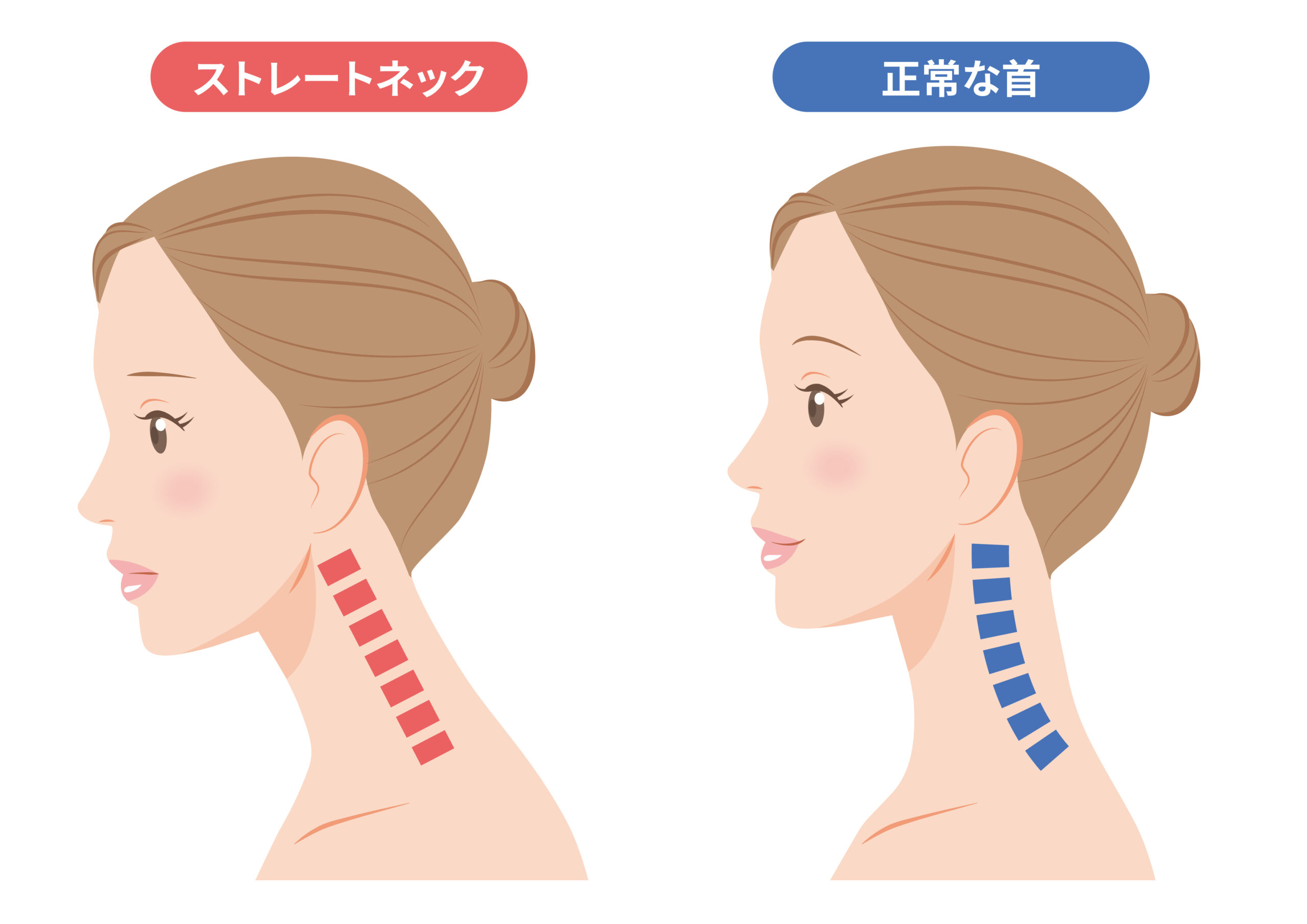 ストレートネックと正常な首の比較図